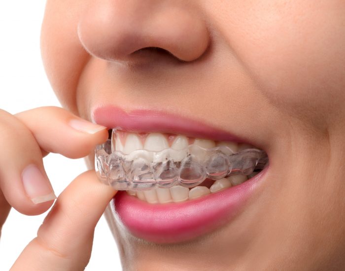 Woman wearing orthodontic silicone trainer. Invisible braces